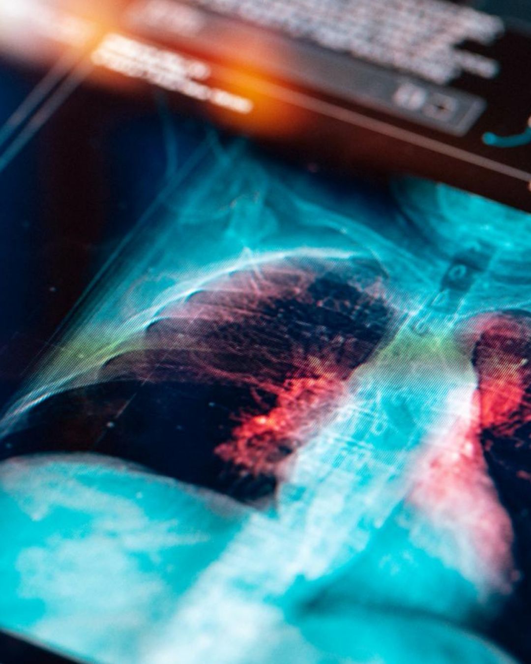 Medical scan/mammogram image with red highlighting over detected areas